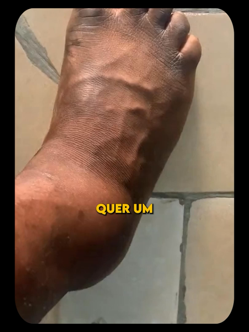Com que frequência você sente suas pernas inchadas? #pernas #inchaco #Dor