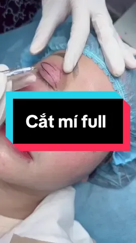 Cận cảnh cắt mí full xử lý da trùng #####catmidepdalat 
