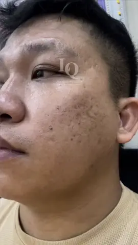 Cập Nhật da sẹo #chamsocdamun#chamsocdanam #chamsocseo#lequynhspa#hocnghespa 