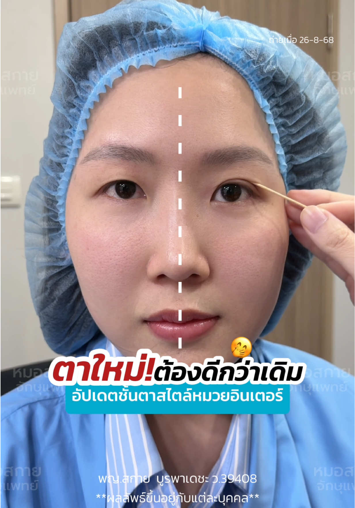 ตาใหม่ต้องดีกว่าเดิม‼️ อัปเดตชั้นตาสไตล์หมวยอินเตอร์ #รีวิวตาสองชั้น #หนังตาเยอะ #หมอสกาย #จักษุแพทย์ #skyclinic