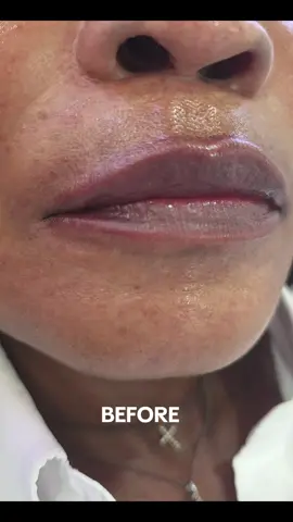 Lip hydration perfect lip treatment. Whatsapp 072 350 6013 for bookings  #skin #lipfiller #lips #antiaging 
