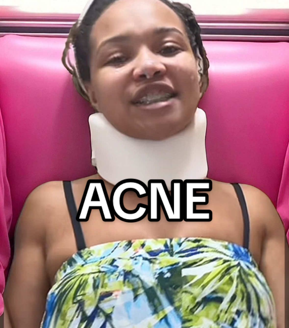 NOT A PAID AD JUST WANT TO PUT YALL ON IF YOUR STRUGGLING WITH ADULT ACNE ❤️ it’s worth it!