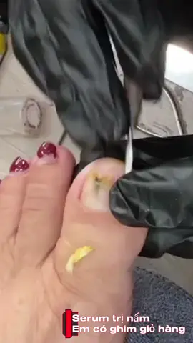 Serum trị nấm móng liệu trình 3-5 chai. #laykhoe #laykhoemongchan #serumnammong #thuoctrinammong #nail 