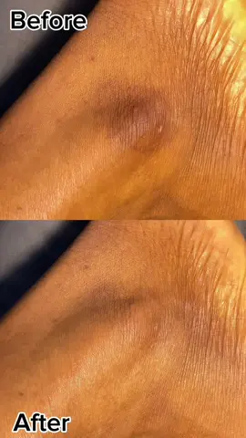 Dark ankle?…nah Centella tone brightening ampoule got ya😉@SKIN1004 US  	#GoViralWithSKIN1004Challenge #SKIN1004White#skin1004#centella#TikTokMadeMeBuyIt#koreanskincare#kbeauty#skincareroutine