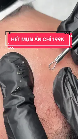 NẶN MỤN CHUẨN Y KHOA – DA SẠCH ĐẸP TỰ TIN 💥 Xem mà mê luôn! 😍 Kỹ thuật viên nặn mụn tỉ mỉ, chuẩn y khoa, sạch sâu từng nhân mụn ẩn – không đau, không thâm. ✨ Da thông thoáng, mịn màng ngay sau buổi đầu ✨ Quy trình an toàn, dụng cụ vô khuẩn tuyệt đối ✨ Hiệu quả rõ rệt chỉ sau vài buổi Đừng để mụn làm bạn mất tự tin! 📩 Inbox ngay để được tư vấn và đặt lịch nặn mụn hôm nay – slot có hạn! 🔥 #spa #viral #tssglowlab #hếtmun 