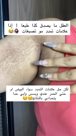 تشققات؟ تمدد؟ إحراج؟ حبيبتي… كلنا مرينا بهالمرحلة، بس الحل الحين صار سهل 💛 ✨ زيت السترتش ماركس من أم سعود ✨ مو بس زيت... هذا لمسة سحر لبشرتج! 🌿 كولاجين يشد 🌿 إيلاستين يرجّع النعومة 🌿 فيتامين E وC يغذّي ويوحّد 🌿 خلاصة الصبّار ترطّب وتبرد يفتح، يشد، ويخلّي بشرتج مثل الحرير 🍯 من أول أسبوع، بتقولين: 