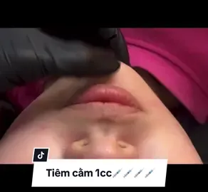 Tiêm cằm 1cc tại :TRANG KEM EMILY 