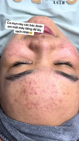 Mấy nay toàn ăn ngủ với siêu mụn🥹 #nặnmunbangtay #ilovetiktok #nặnmunsiêuphê 