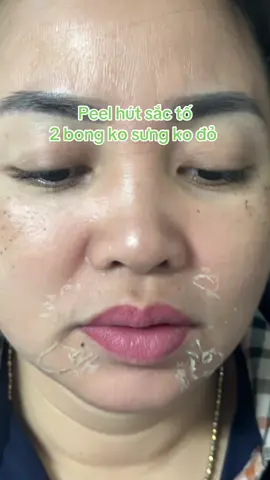 Peel hút sắc tố. #beauty  #peelda  #peeldaantoan  #lamdep #phunututin 