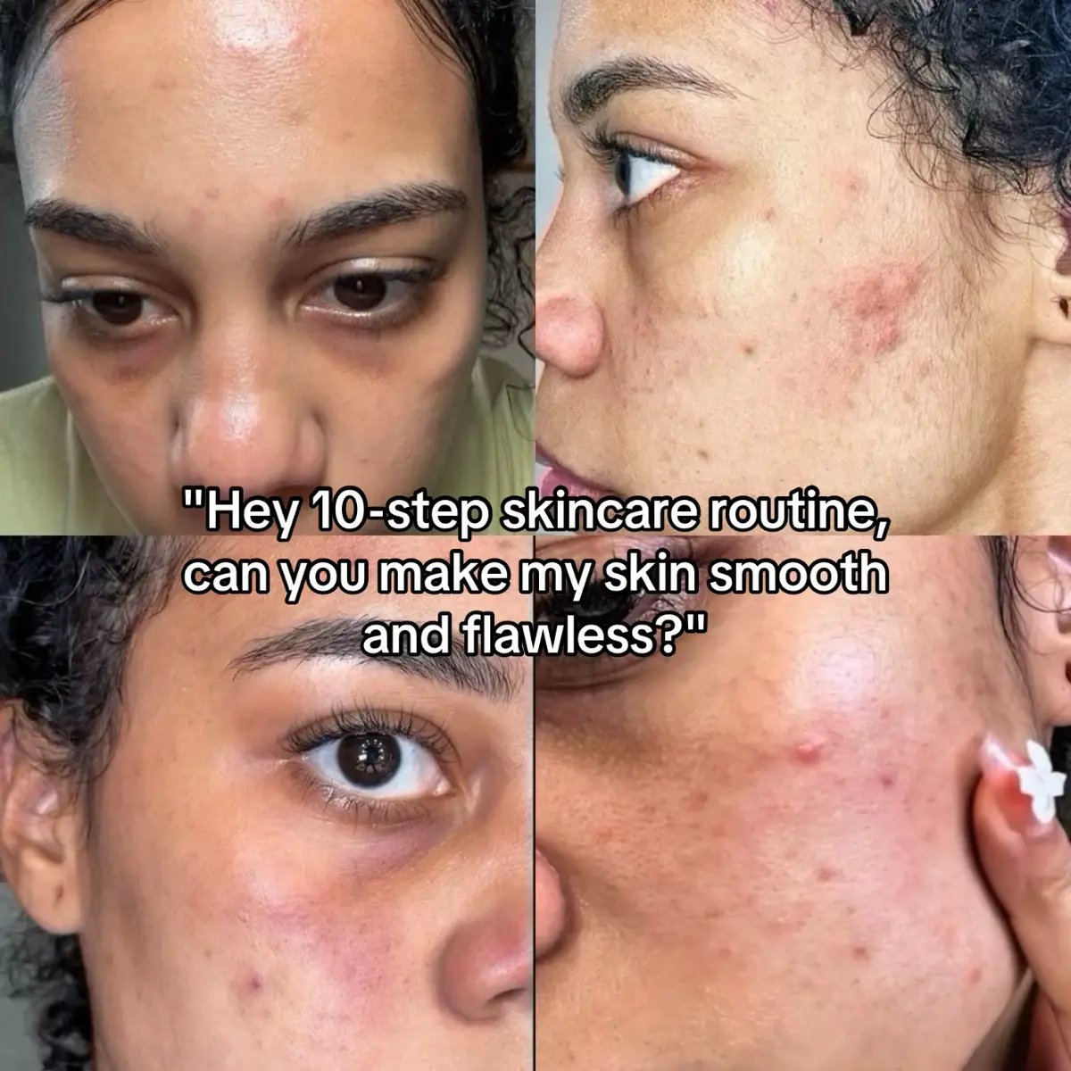 after two months of trying this duo i can never go back ❤️‍🩹 #acnejourney #acneproneskin #skintok #beautyofjoseon #koreanskincare @Beauty of Joseon 