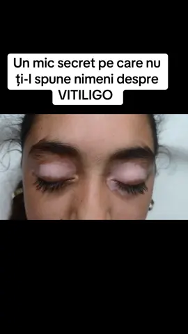 Mulți oameni se confruntă cu VITILIGO . Dacă și tu cunoști pe cineva ,arată i cum poate scapă de el . Skin Story  0723 291 345 pt programări Constanța și București  #CamuflareVitiligo #camuflagemvitiligo #vitiligo #Dermopigmentare #vitiligo 