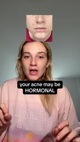 obsessed is an understatement #smnutrition #acne #probiotics #hormones #supplement 