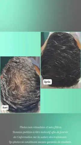 علاج تساقط الشعر  #chutecheveux #aga #صلع_وراثي