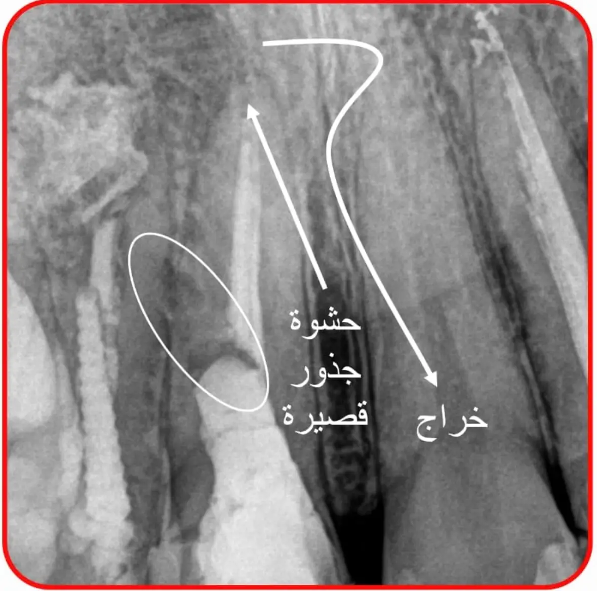 من احد العلاجات المتقدمة في تخصص علاج جذور وعصب الأسنان المجهري هو ما يعرف ب intentional replantation، او خلع السن واعادة غرسه.. نستخدمه في الحالات اللي ما نفضل نعملها علاج جراحي بسبب مشاكل داخل العظم ولا نقدر نسويها علاج غير جراحي.. في هذي الحالة المراجعة عملت ابتسامة جديدة وعاجبتها وماتبغا تفكها، وفي نفس الوقت عندها خراج وثقب في السن.. العلاجات المتقدمة دايما فعالة 😎😎 #viral  #عصب_الاسنان  #اكسبلور  #تجميل_الاسنان  #fyp 