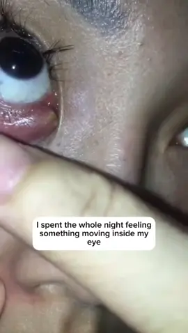 after my cat licked my eye I had to rush to the hospital with something moving inside my eye until #cat #eye #worm #ophthalmologist #hospital 