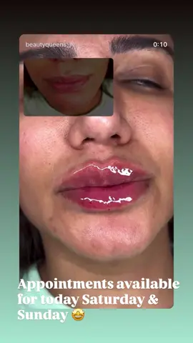 Follow me on Instagram to book @beautyqueens_lv #microneedle #lasvegas #lipfillerlasveg 