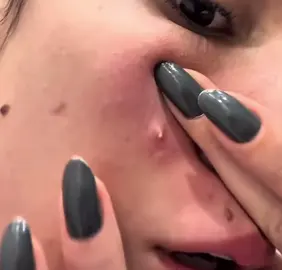 #cravoseespinhas #cravos #pimplepatch #satisfaction 