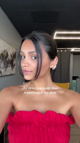 If you’ve been curious about micro needleing with  PRP you need to see my favorite @Tampa Injector🫶🏻 she will transform your skin #microneedling #microneedlingprp #skincare #glasskin 