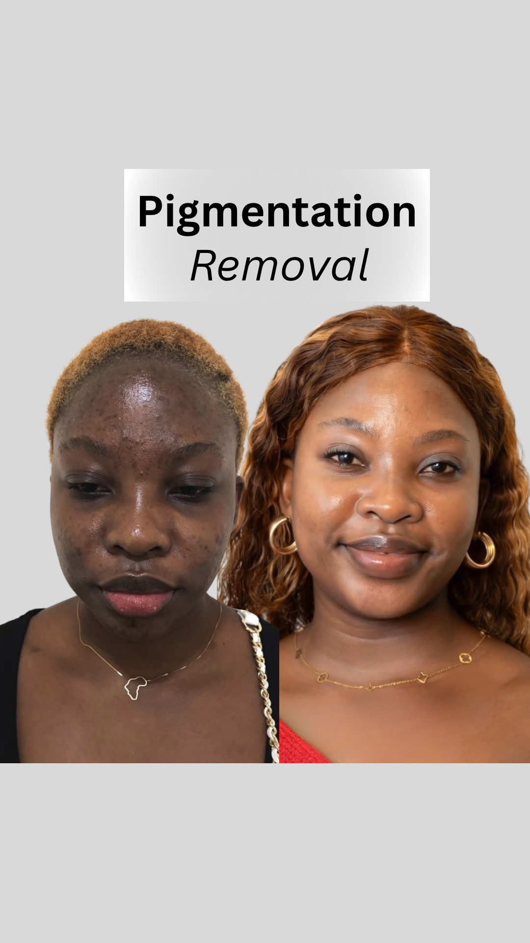✨ A clearer future for your skin. Our advanced depigmentation technology works at the root — targeting excess melanin without altering your natural skin tone. Precision. Safety. Long-term balance. ✔ Visible clarity in darker skin tones ✔ Excess melanin de-rooted for lasting results ✔ Ongoing care to help keep pigmentation away This isn’t just treatment. It’s a new standard for healthy, balanced skin. 📲 DM us to begin your personalised pigmentation journey with Este Medical Group. #pigmentation #hyperpigmentation #melasma 