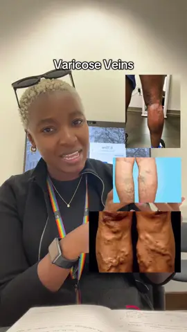 Varicose Veins #varicoseveins #varicoseveinstreatment #drlethukwenama #tipsforbetterhealthandliving #healtheeucationsouthafrica 