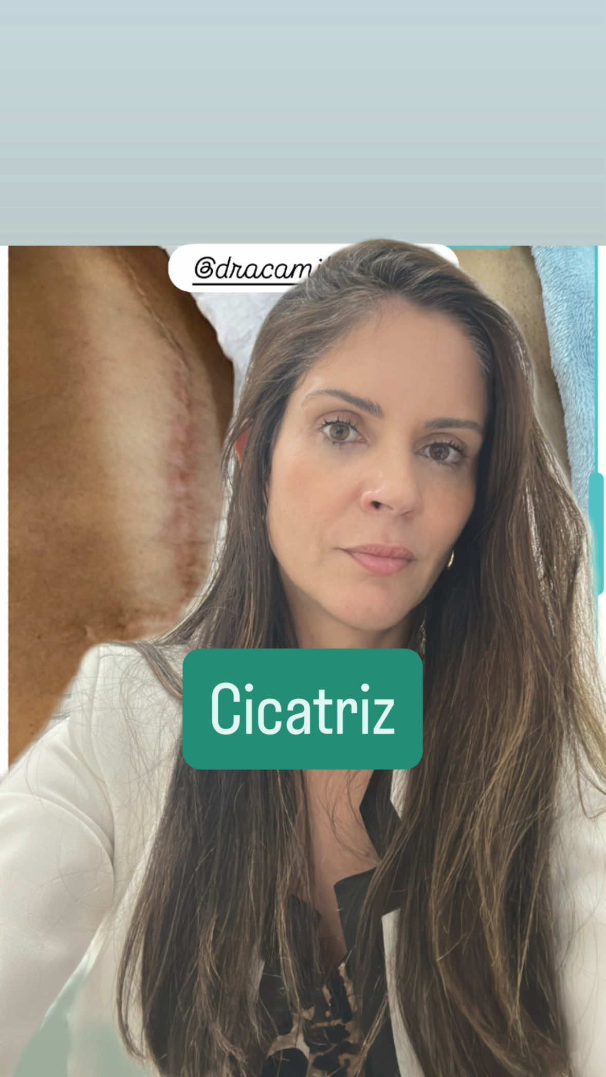 Sua cicatriz pode melhorar mesmo que ela seja antiga! A nossa clínica possue as melhores tecnologias do mercado para entregar excelentes resultados, com segurança ! O FOTONA é uma das nossas tecnologias que só nos surpreende positivamente! #fotonastarwalker #cicatriz #cesarea #dracamilasimon #dermatologia 
