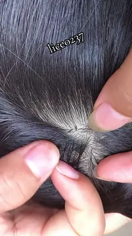 😱 #omG #lice #liceremoval #trending #fyp 