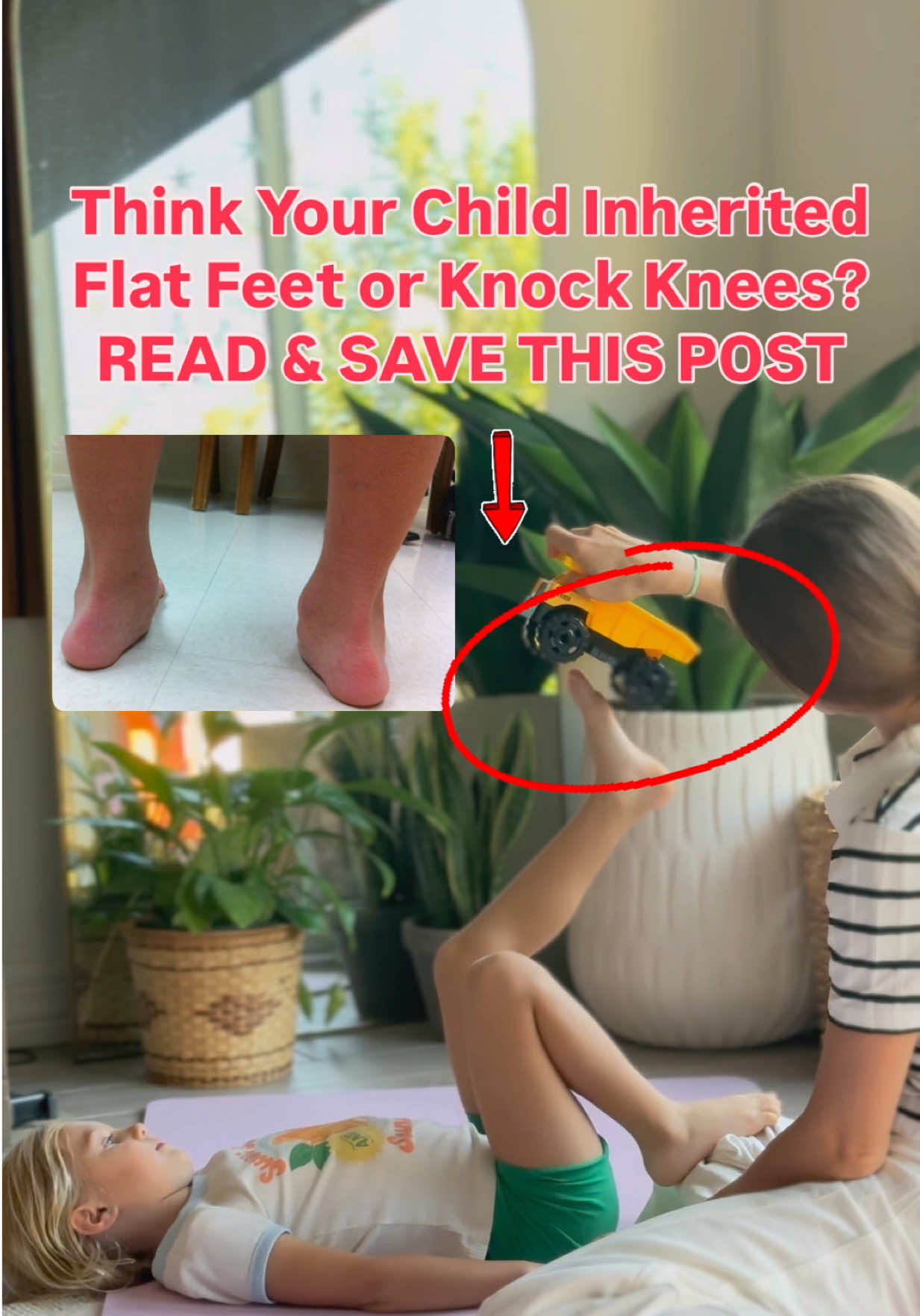 Yes, valgus foot positioning can have a genetic predisposition, but this doesn’t mean a child is born with the condition itself. Instead, what is inherited is the quality of connective tissues, muscle tone, and joint flexibility, which may increase the likelihood of developing valgus over time. 🧬 What This Means: 🔹 A child doesn’t inherit valgus itself, but they may inherit weaker connective tissues, ligament laxity, or poor muscle tone, which can contribute to misalignment. 🔹 Genetics alone isn’t the cause—valgus often develops due to a combination of weak muscles, poor movement habits, and external factors like improper footwear or lack of barefoot time. 🔹 Environmental factors play a huge role—even a genetically predisposed child can develop strong, stable feet with the right exercises and movement habits. 💡 The Good News: With the right intervention—such as strengthening exercises, posture correction, and proper footwear—valgus can be improved or even prevented, especially in early childhood!