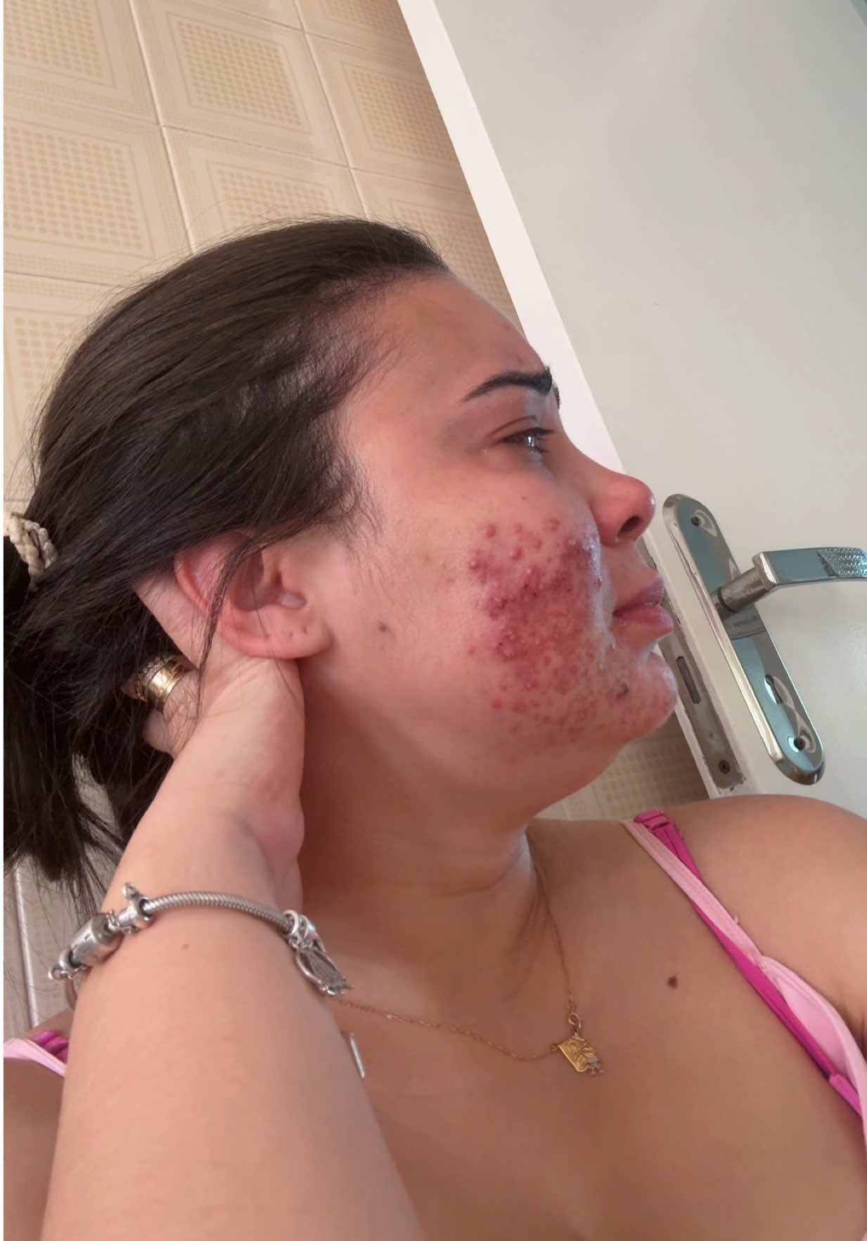 Não é todo dia que tá tudo bem, as vezes pesa e pesa muito e sabe de uma coisa ? É normal! É normal chorar, até por que eu não estou feliz com o que estou passando mesmo sabendo que é uma fase !  Esse vídeo tava nos meus rascunhos mais eu tinha que ter ele aqui no perfil pra olhar pra ele e ver o quanto sofri mais consegui superar e quem tiver comigo e tiver passando por isso vai superar também!!! Eu creio!! #SOP #isotretinoina #roacutan #viraltiktok #espinha 