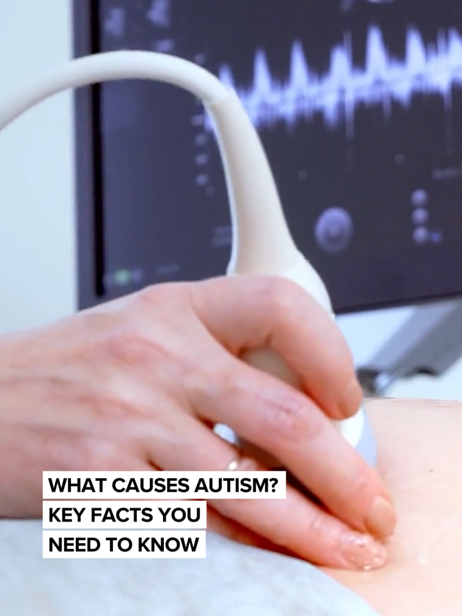 President Donald Trump on Monday used the platform of the presidency to promote unproven and in some cases discredited ties between Tylenol, vaccines and autism as his administration announced a wide-ranging effort to study the causes of the complex brain disorder. Health Secretary Robert F. Kennedy Jr. promised earlier this year to determine the cause of autism by September. That baffled brain experts who say there is no single cause and that the rhetoric appears to ignore decades of science into the genetic and environmental factors that can play a role. Here's what we know about autism. #autism #tylenol #trump #RFK #HHS #Science #kids #fyp #news #foryoupage