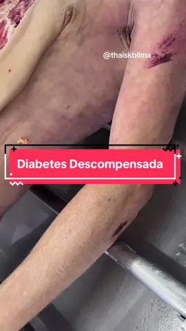 📊 Estatísticas principais 	•	Em 2021, o diabetes e as doenças renais causadas pelo diabetes foram responsáveis por mais de 2 milhões de mortes no mundo.   	•	Além disso, níveis altos de glicose no sangue contribuíram para cerca de 11% das mortes por doenças cardiovasculares.   	•	Estima-se que, em 2019, cerca de 4,2 milhões de adultos (idade entre 20 e 79 anos) morreram por diabetes ou suas complicações — isso correspondia a cerca de 11,3% de todas as mortes nesse grupo de idade.   	•	No Brasil, em 2015, foram registradas cerca de 62.466 mortes atribuídas diretamente ao diabetes.  