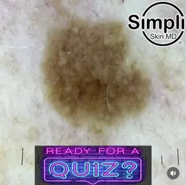 What’s this fellow? Answer in two days! A. Lichenoid Keratosis B. Dysplastic Nevus C. Pigmented Squamous Cell Carcinoma D. Melanoma Music Credit: Taylor Swift - Dress #dermoscopy #derm #dermatology #dermatologist #simpliskinmd 