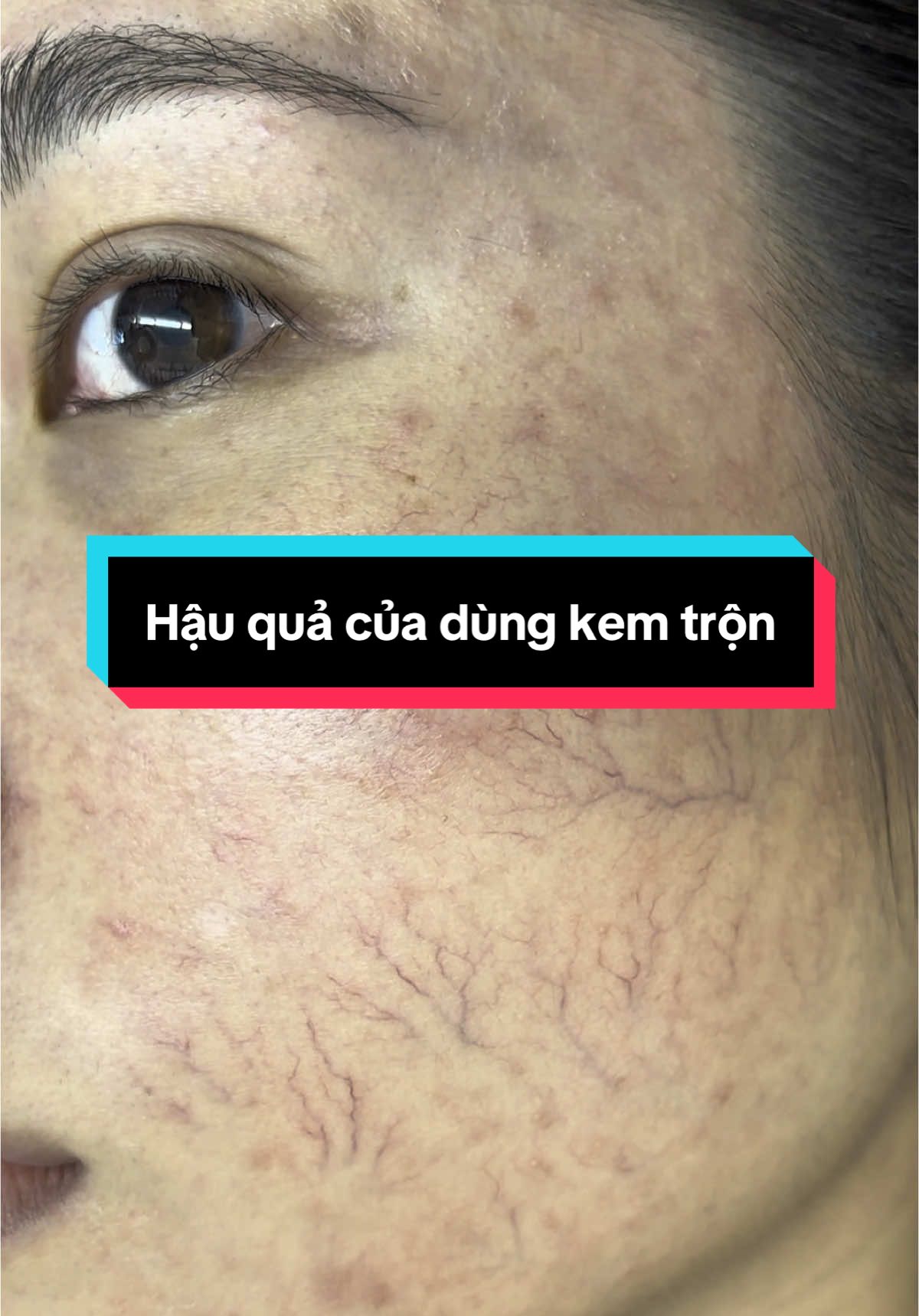 Hậu quả nặng nề do dùng kem trộn ở bạn gái rất trẻ tuổi. Dấu hiệu điển hình, mà khiến bệnh nhân phải đi khám gấp, không phải là giãn mao mạch, mà là ngứa. 70-80% bn ngứa thường xuyên, từng cơn. #bschumui #kemtron #sẹo #mụn #xuhuong 
