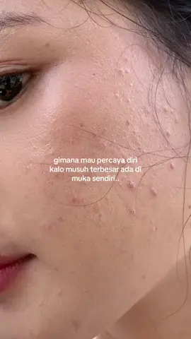 how can.. #acnefighter 