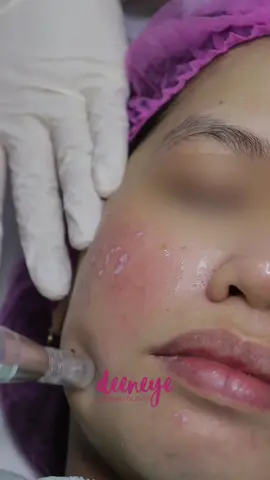 Smooth, clear, and glowing skin—yes, it’s possible! ✨ Our TCA CROSS + Microneedling treatment works hand-in-hand to target acne scars, refine skin texture, and boost collagen for that soft-glow finish. 🌸💆🏻‍♀️ 📍 Available at Deeneye Dermatology, Lipa City. Your journey to scar-free, radiant skin starts here. 💖 📲 Achieve that glow! Book your appointment today. #DeeneyeDermatology #boardcertifieddermatologist #TCAcross #Microneedling #ScarTreatment           