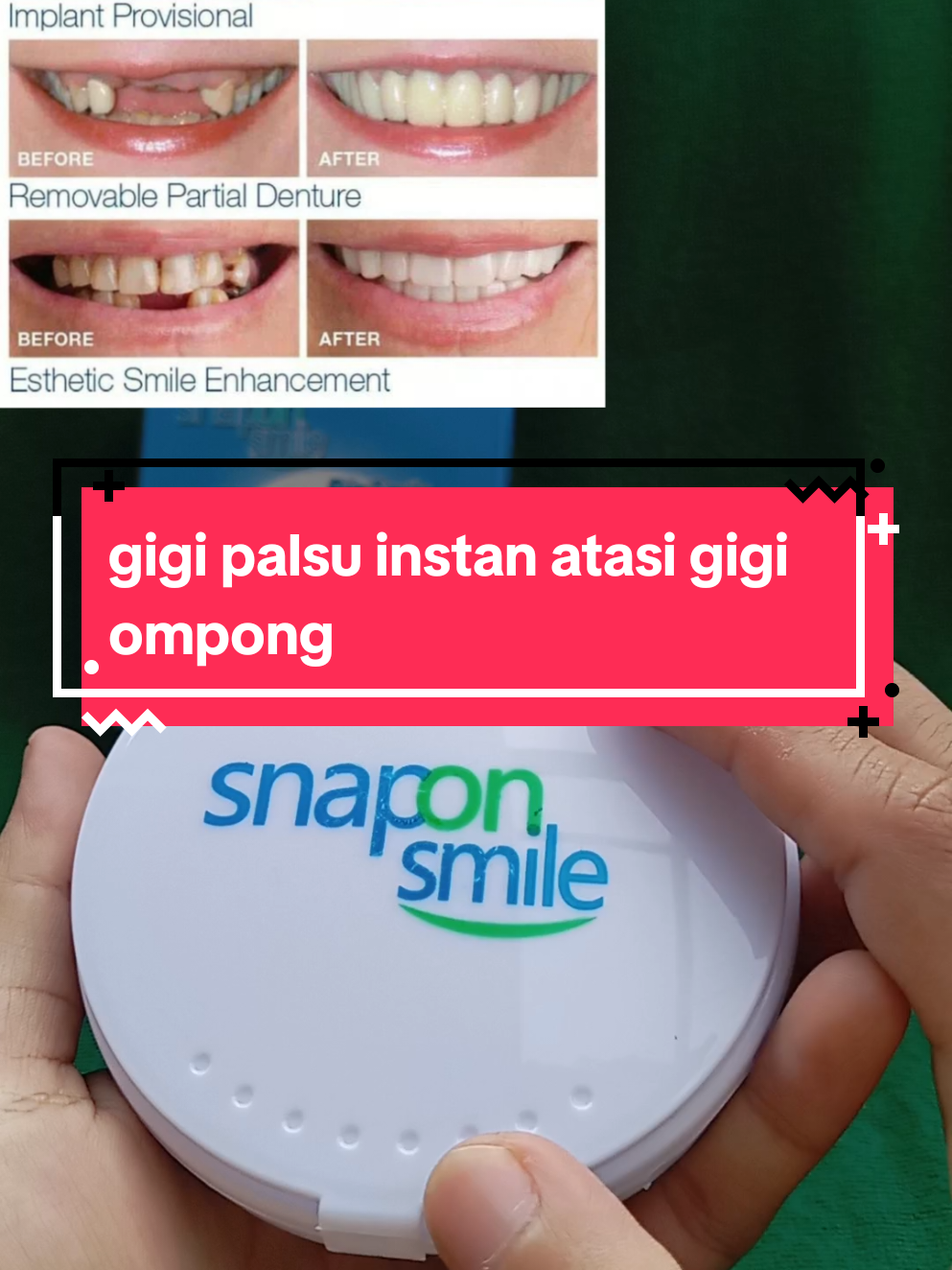 snap on smile solusi penutup gigi ompong, berjeda dan tidak rapih, bahan fleksibel tidak sakit di mulut#snaponsmile #gigitiruan #gigipalsulepasan #gigiberlubang 
