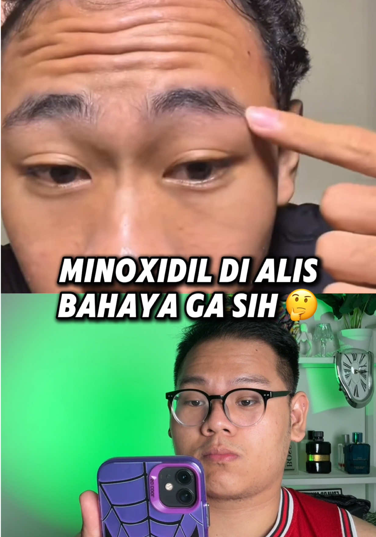 izin stitch ya @mas_bimz, and gokil bgt hasil nya di lu 👍 #minoxidil #alis #penumbuhrambut #thelittlekrisna 