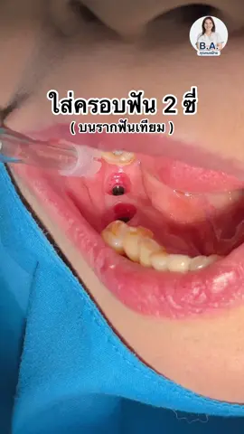 รากฟันเทียมยี่ห้อ osstem 🦷✨ #รากฟันเทียม #ใส่ครอบฟัน #รากฟันเทียมหมอฝ้าย #คลินิกทันตกรรมบีเอปทุมธานี #หมอฟันtiktok 