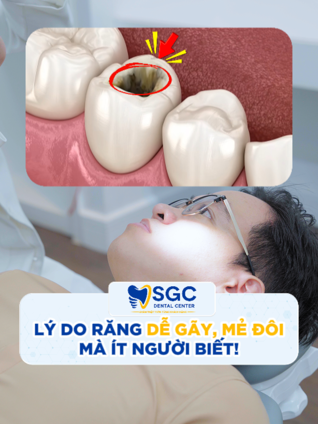 Không ngờ răng bể làm đôi vẫn có thể giữ lại được! #dieutrituyrang #tramrang #rangsu #nhakhoauytin #nhakhoasgc