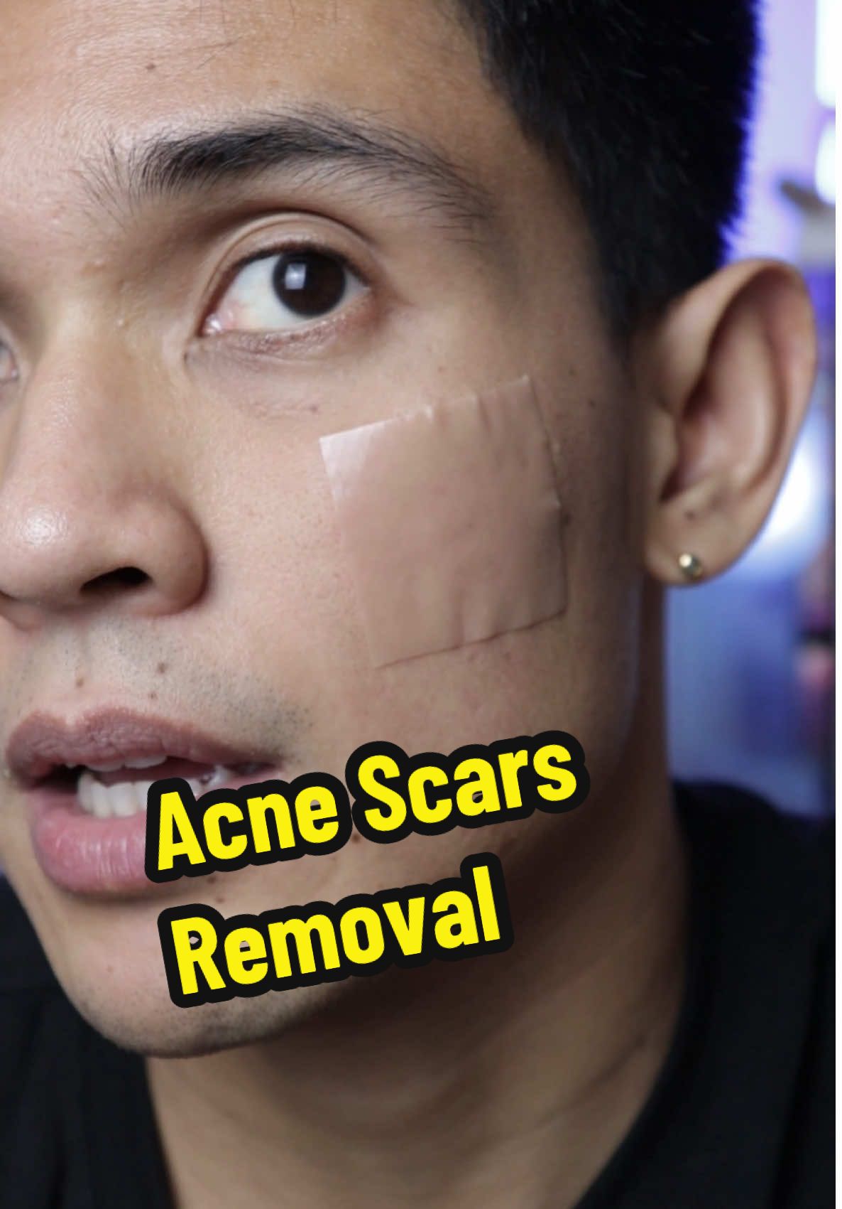 Epektibo naman pala ito sa mga acne at acne scars #acnescars #scarremoval #acnetreatment 