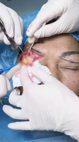 Nâng cung chân mày dấu chỉ 