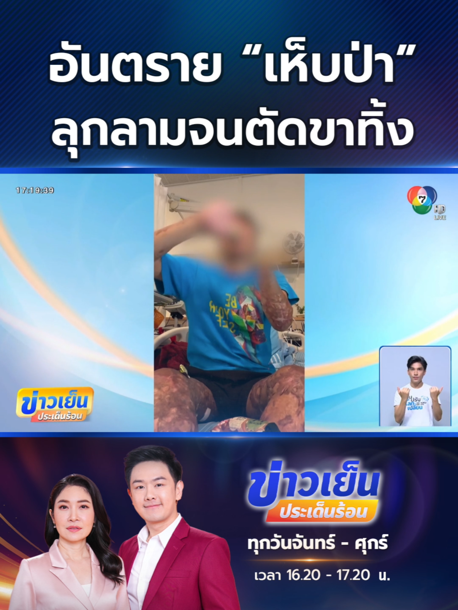 อุทาหรณ์! #เห็บ กัดอันตรายกว่าที่คิด แรงงานไทยคนหนึ่ง ไปโดนเห็บกัด จากแผลเล็ก ๆ แต่ลุกลามถึงขั้นต้องตัดแขนตัดขาทิ้ง จนกลายเป็นคนพิการ #Ch7HDNews #ข่าวออนไลน์7HD #ข่าวTikTok