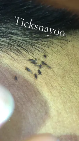 remove and stop itching#omg😱😱😱 #lice😰😰😰 #😭😭😭 #tripofobia😮😥 #liceremoval 