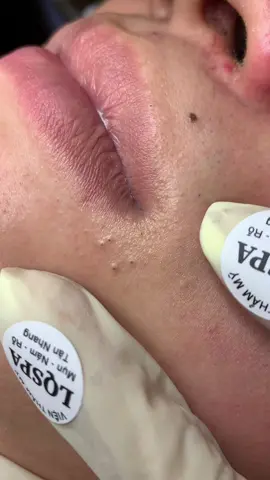 Cộm #chamsocdaseo#chamsocda#chamsocdamun#chamsocdanam#tanbinh       