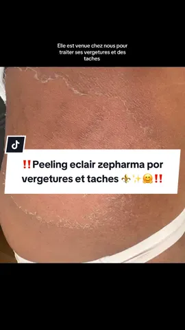 👉🏿Vous avez des cicatrices ou des taches sombres sur la peau ? ‼️✨ Ce n’est pas une fatalité. Avec le peeling, dès la première séance, la peau commence à se renouveler et les résultats sont visibles.🤩🤗✨🌺 😀Ne cachez plus votre beauté, révélez-la. 💫 Osez faire le premier pas, comme elle, et offrez à votre peau une nouvelle histoire. 💕 👉🏿Réservez votre séance dès aujourd’hui et découvrez la transformation. 📍75 Rue de Rendez-vous 75012 Paris ☎️06 11 98 94 82  #zepharma #pourtoii #soinsdelapeau #peeling #xyzabc 