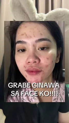 Grabe ka! @shopwithbonita. Ang lala ng ginawa mo sa face ko. 😭😭😭 #bonita #bonitaoil #bonitahimalayanpinksaltoil #himalayanoil #acnemarks 