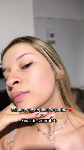 o tanto que Deus é perfeito 🥹❤️ restaurou a minha pele  #espironolactona #vitacidacne #pele #acneskin #tretinoina 