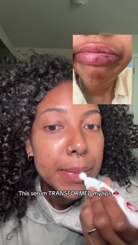 From dark to dazzling 💋✨ — Jinshane Lip Serum revives and transforms your lips with every drop #kbeauty #darklips #hyperpigmentation #lipserum #smokerslips 