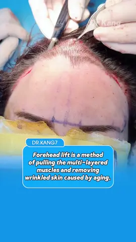 Forehead lift is a method of pulling multi-layered muscles and removing excess skin to rejuvenate the face. #drkang #sydney #viral #beauty #forehead 