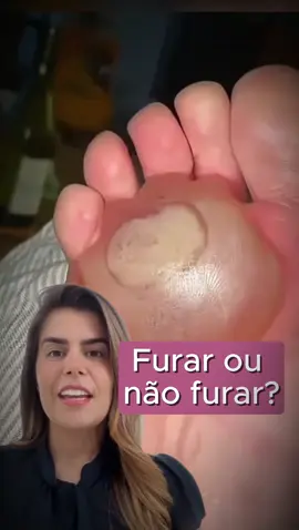 Pode parecer inofensivo, mas furar uma bolha abre as portas para infecções, principalmente em pessoas com imunidade baixa ou diabetes. A bolha é um mecanismo de defesa do seu corpo, protegendo a pele lesionada enquanto ela se regenera. Se ela não dói, não está com pus ou sinais de infecção, o melhor a fazer é não mexer, proteger com um curativo limpo e deixar o corpo fazer seu trabalho. ⚠️  Mas atenção: se estiver muito grande, dolorida, com líquido turvo, vermelhidão ou febre, procure um serviço de saúde. Não vale o risco de transformar algo simples em uma complicação. 👉 Compartilhe com quem já passou por isso! Dra. Lauren Zogbi Médica Infectologista CRM-MS 7405 | RQE 6481 #infectologia #bolha #naofureabolha #cuidadoscomapele #prevenção     