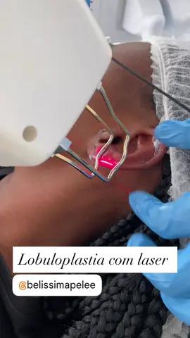 🌸 Lobuloplastia com Laser – Restaure a Beleza dos Seus Lóbulos 🌸 O que é? A lobuloplastia é um procedimento estético que corrige rasgos ou alargamentos no lóbulo da orelha causados por brincos pesados, plugs ou acidentes. Com o uso do laser, a técnica é moderna, precisa e promove uma cicatrização mais estética. ⸻ ✨ Benefícios do Laser ✅ Corte delicado e preciso ✅ Menos sangramento e desconforto ✅ Cicatrização mais rápida ✅ Risco reduzido de queloides ou cicatrizes visíveis ✅ Resultado natural e harmonioso